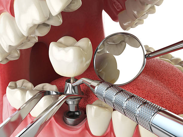 Best Emergency Tooth Extraction in Ardmore, TN